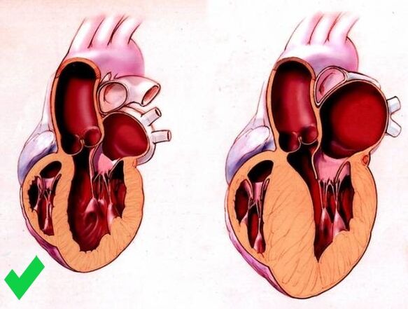 Cardione sprječava ventrikularnu hipertrofiju srca